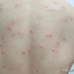 丘疹性湿疹,症状、成因及防治策略解析